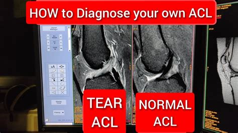 how to diagnose acl injury